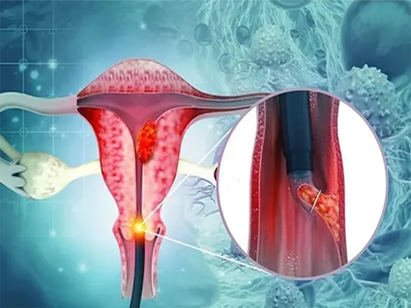 چسبندگی رحم